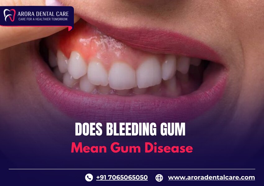 Does Bleeding Gum Mean Gum Disease?